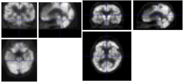 Figure 4 for Introducing an ensemble method for the early detection of Alzheimer's disease through the analysis of PET scan images
