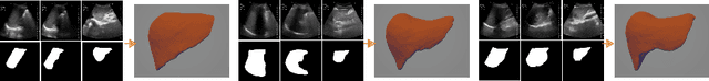 Figure 3 for LiverUSRecon: Automatic 3D Reconstruction and Volumetry of the Liver with a Few Partial Ultrasound Scans