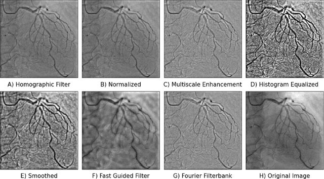 Figure 2 for YOLO-Angio: An Algorithm for Coronary Anatomy Segmentation