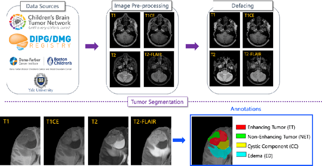 Figure 1 for The Brain Tumor Segmentation in Pediatrics (BraTS-PEDs) Challenge: Focus on Pediatrics (CBTN-CONNECT-DIPGR-ASNR-MICCAI BraTS-PEDs)
