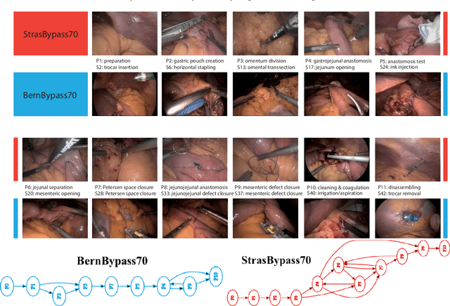 Figure 1 for Challenges in Multi-centric Generalization: Phase and Step Recognition in Roux-en-Y Gastric Bypass Surgery