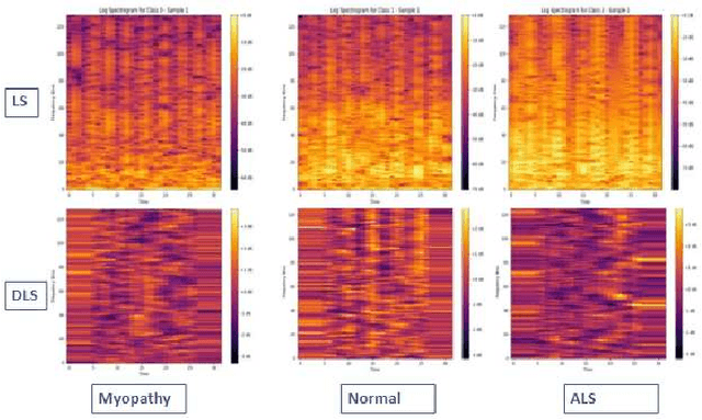 Figure 2 for EMG Signal Classification for Neuromuscular Disorders with Attention-Enhanced CNN