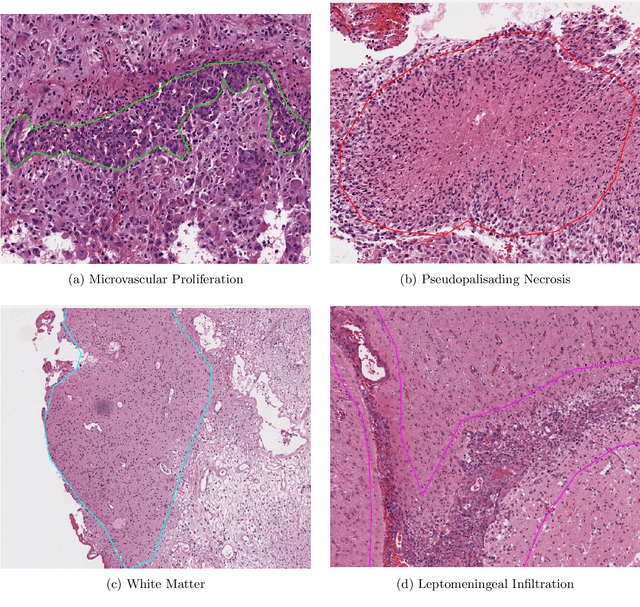 Figure 4 for BraTS-Path Challenge: Assessing Heterogeneous Histopathologic Brain Tumor Sub-regions