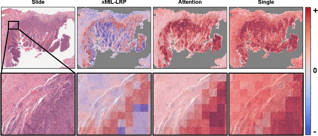 Figure 1 for xMIL: Insightful Explanations for Multiple Instance Learning in Histopathology