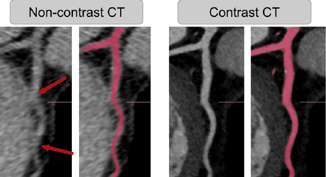 Figure 1 for Coronary artery segmentation in non-contrast calcium scoring CT images using deep learning