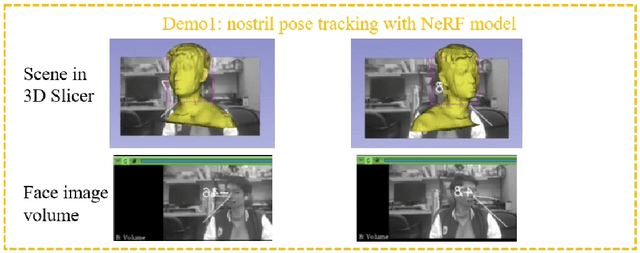 Figure 4 for Head Pose Estimation and 3D Neural Surface Reconstruction via Monocular Camera in situ for Navigation and Safe Insertion into Natural Openings