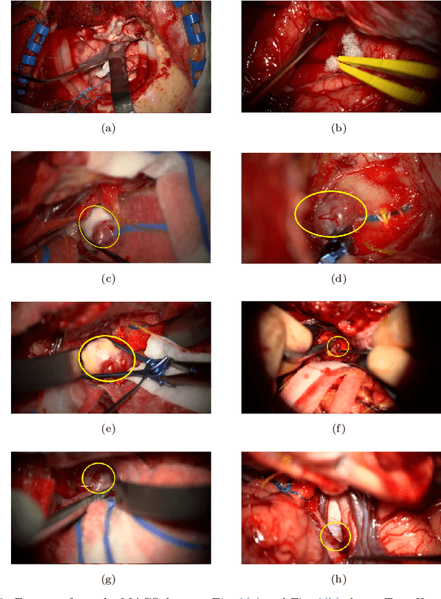 Figure 3 for Shifted-Windows Transformers for the Detection of Cerebral Aneurysms in Microsurgery