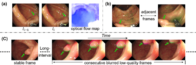 Figure 1 for SALI: Short-term Alignment and Long-term Interaction Network for Colonoscopy Video Polyp Segmentation