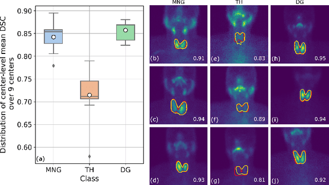 Figure 3 for Thyroidiomics: An Automated Pipeline for Segmentation and Classification of Thyroid Pathologies from Scintigraphy Images