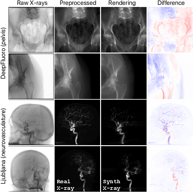 Figure 4 for Intraoperative 2D/3D Image Registration via Differentiable X-ray Rendering