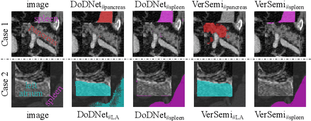 Figure 3 for Segment Together: A Versatile Paradigm for Semi-Supervised Medical Image Segmentation
