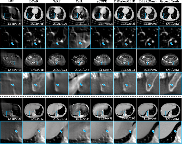 Figure 3 for DPER: Diffusion Prior Driven Neural Representation for Limited Angle and Sparse View CT Reconstruction