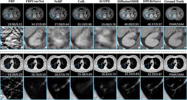 Figure 4 for DPER: Diffusion Prior Driven Neural Representation for Limited Angle and Sparse View CT Reconstruction