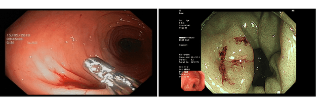 Figure 1 for The unreasonable effectiveness of AI CADe polyp detectors to generalize to new countries