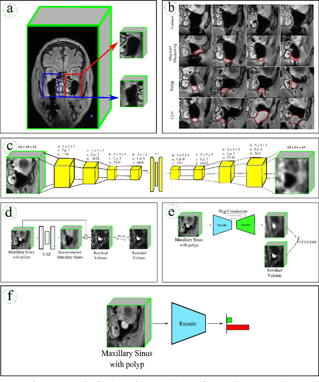 Figure 1 for Self-supervised learning for classifying paranasal anomalies in the maxillary sinus