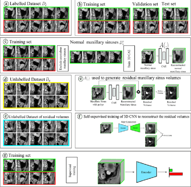 Figure 3 for Self-supervised learning for classifying paranasal anomalies in the maxillary sinus