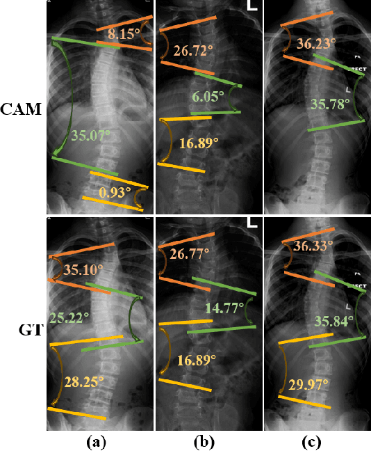 Figure 1 for A Landmark-aware Network for Automated Cobb Angle Estimation Using X-ray Images