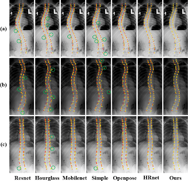 Figure 4 for A Landmark-aware Network for Automated Cobb Angle Estimation Using X-ray Images