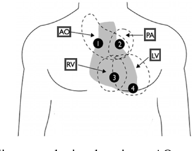 Figure 1 for Heart Murmur and Abnormal PCG Detection via Wavelet Scattering Transform & a 1D-CNN