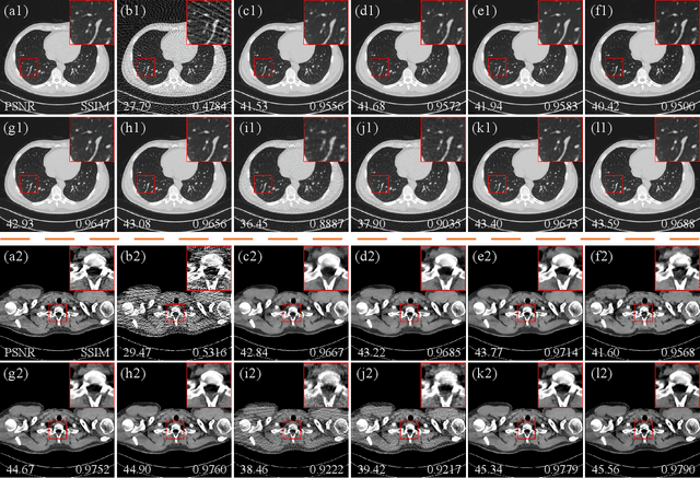 Figure 4 for MVMS-RCN: A Dual-Domain Unfolding CT Reconstruction with Multi-sparse-view and Multi-scale Refinement-correction