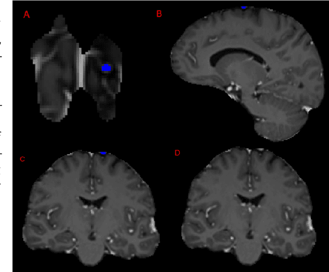 Figure 4 for Analysis of the BraTS 2023 Intracranial Meningioma Segmentation Challenge