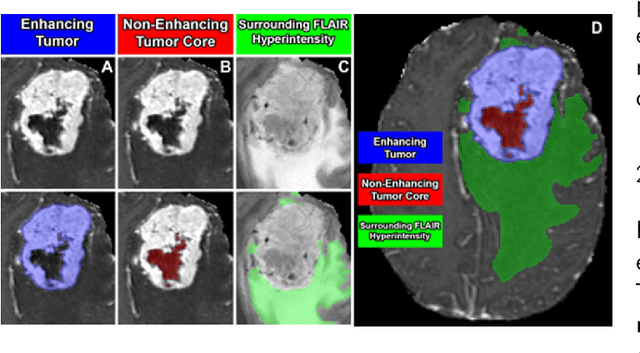 Figure 1 for Analysis of the BraTS 2023 Intracranial Meningioma Segmentation Challenge