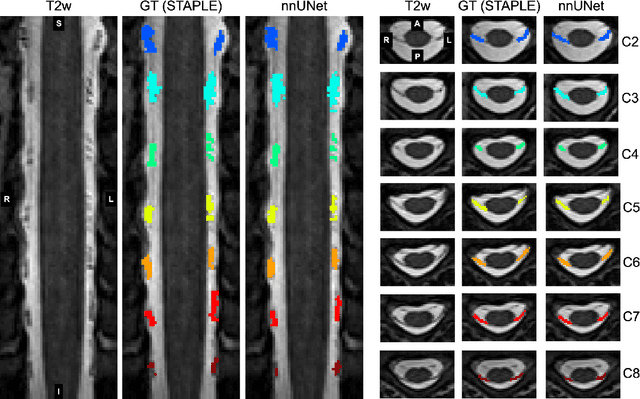 Figure 3 for Automatic Segmentation of the Spinal Cord Nerve Rootlets