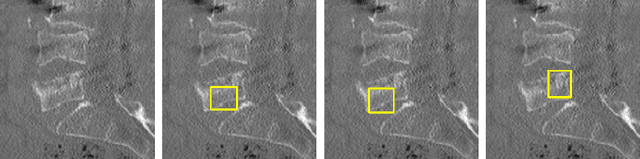 Figure 1 for Enhancing Interpretability of Vertebrae Fracture Grading using Human-interpretable Prototypes