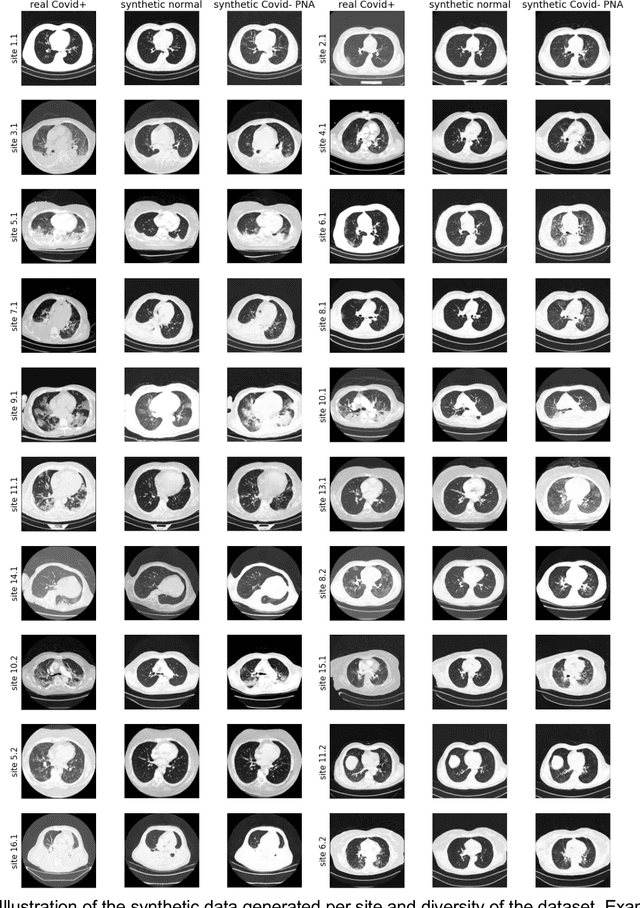 Figure 3 for Federated Learning on Heterogenous Data using Chest CT