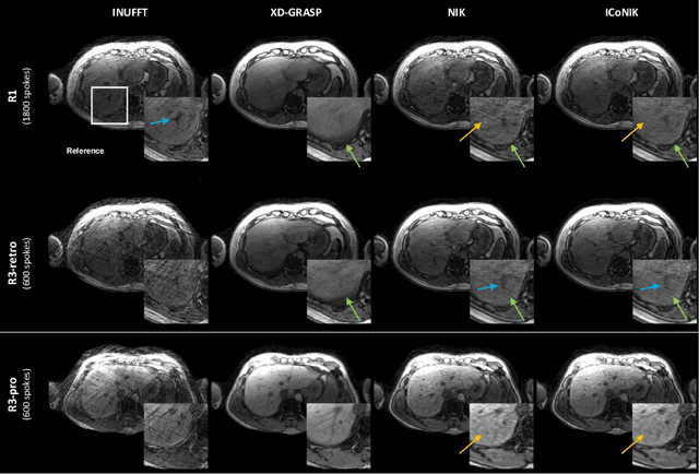 Figure 3 for ICoNIK: Generating Respiratory-Resolved Abdominal MR Reconstructions Using Neural Implicit Representations in k-Space