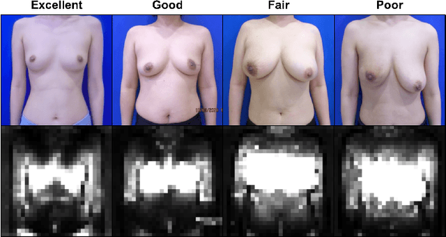 Figure 3 for Objective and Interpretable Breast Cosmesis Evaluation with Attention Guided Denoising Diffusion Anomaly Detection Model