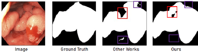 Figure 1 for Adaptation of Distinct Semantics for Uncertain Areas in Polyp Segmentation