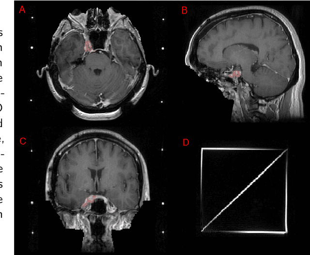 Figure 1 for Brain Tumor Segmentation (BraTS) Challenge 2024: Meningioma Radiotherapy Planning Automated Segmentation