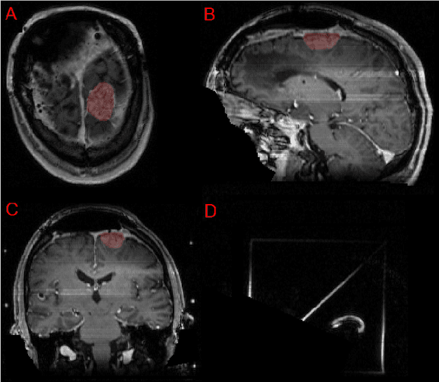 Figure 3 for Brain Tumor Segmentation (BraTS) Challenge 2024: Meningioma Radiotherapy Planning Automated Segmentation