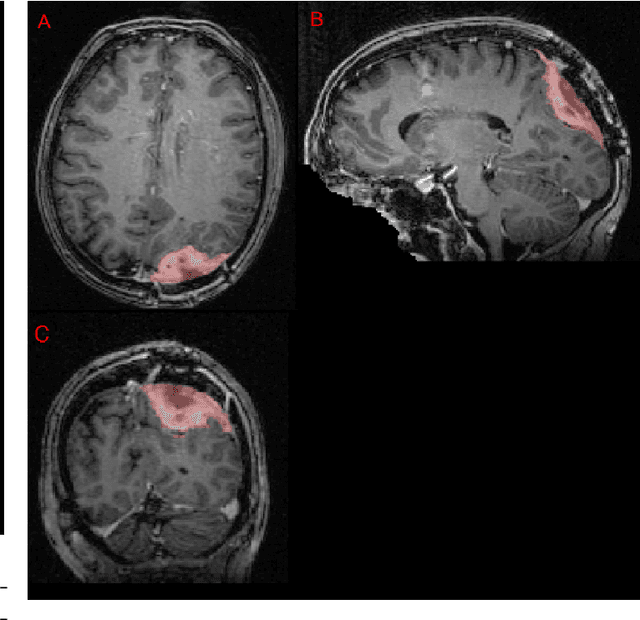 Figure 4 for Brain Tumor Segmentation (BraTS) Challenge 2024: Meningioma Radiotherapy Planning Automated Segmentation