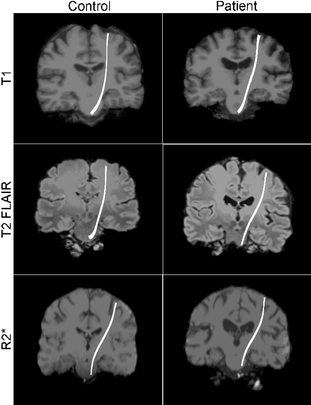 Figure 1 for SF2Former: Amyotrophic Lateral Sclerosis Identification From Multi-center MRI Data Using Spatial and Frequency Fusion Transformer