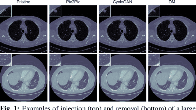 Figure 1 for M3Dsynth: A dataset of medical 3D images with AI-generated local manipulations