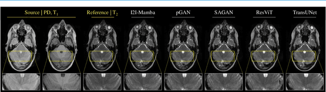 Figure 2 for I2I-Mamba: Multi-modal medical image synthesis via selective state space modeling