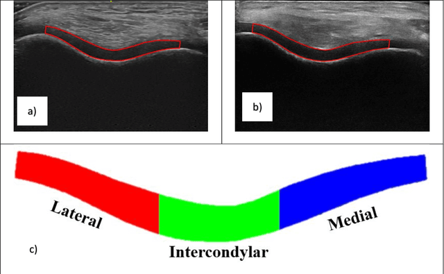 Figure 2 for Wireless vs. Traditional Ultrasound Assessed Knee Cartilage Outcomes Utilizing Automated Gain and Normalization Techniques