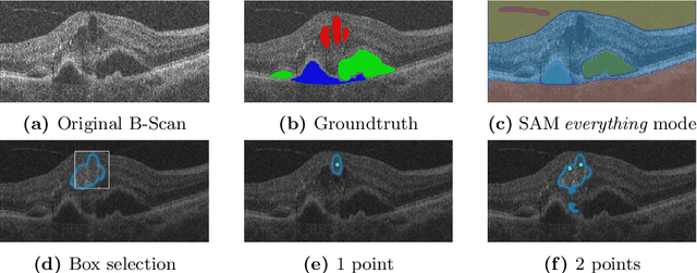 Figure 1 for SAMedOCT: Adapting Segment Anything Model (SAM) for Retinal OCT