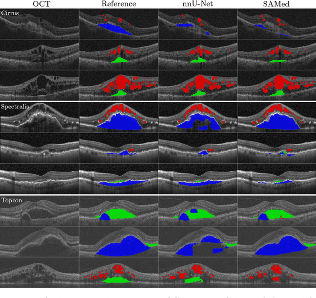 Figure 4 for SAMedOCT: Adapting Segment Anything Model (SAM) for Retinal OCT