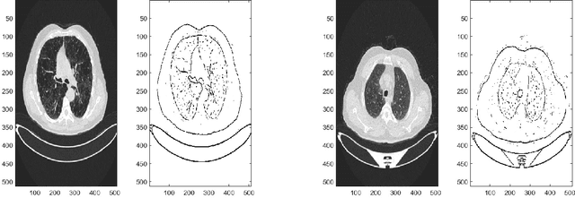 Figure 3 for Local Clustering for Lung Cancer Image Classification via Sparse Solution Technique