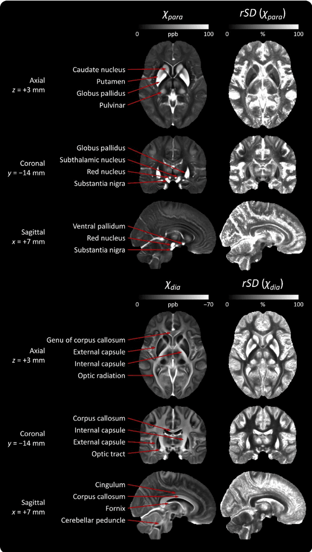 Figure 2 for A human brain atlas of chi-separation for normative iron and myelin distributions