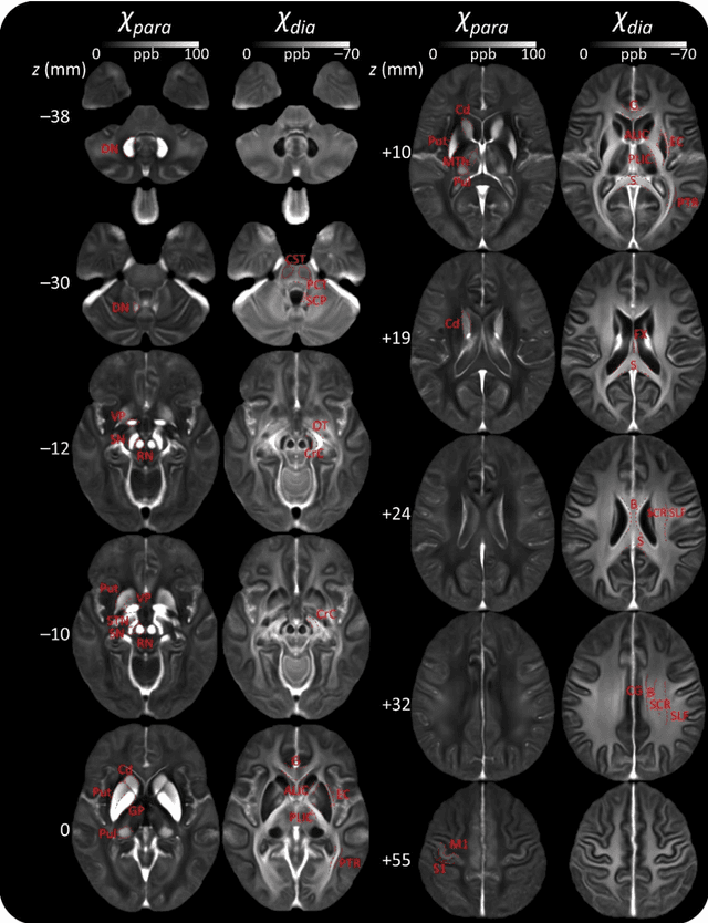 Figure 3 for A human brain atlas of chi-separation for normative iron and myelin distributions