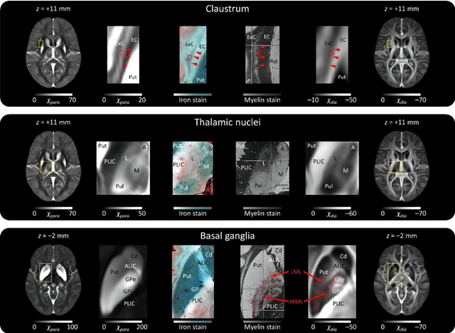 Figure 4 for A human brain atlas of chi-separation for normative iron and myelin distributions