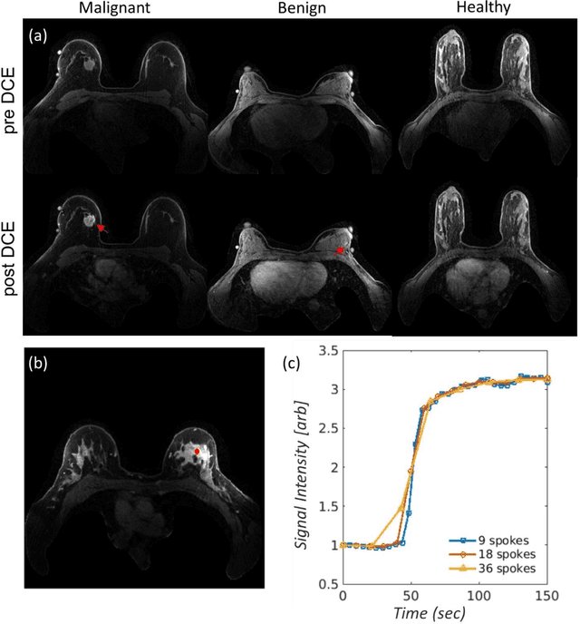 Figure 2 for fastMRI Breast: A publicly available radial k-space dataset of breast dynamic contrast-enhanced MRI