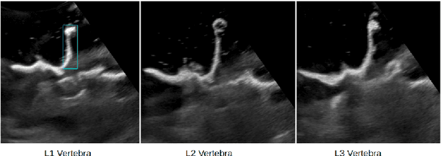 Figure 3 for Shape Completion in the Dark: Completing Vertebrae Morphology from 3D Ultrasound