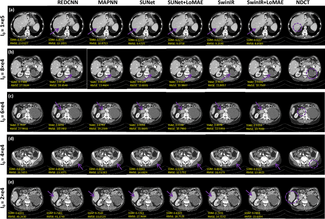 Figure 2 for LoMAE: Low-level Vision Masked Autoencoders for Low-dose CT Denoising