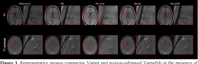 Figure 4 for Motion-Informed Deep Learning for Brain MR Image Reconstruction Framework