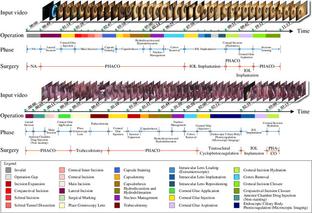 Figure 3 for OphNet: A Large-Scale Video Benchmark for Ophthalmic Surgical Workflow Understanding